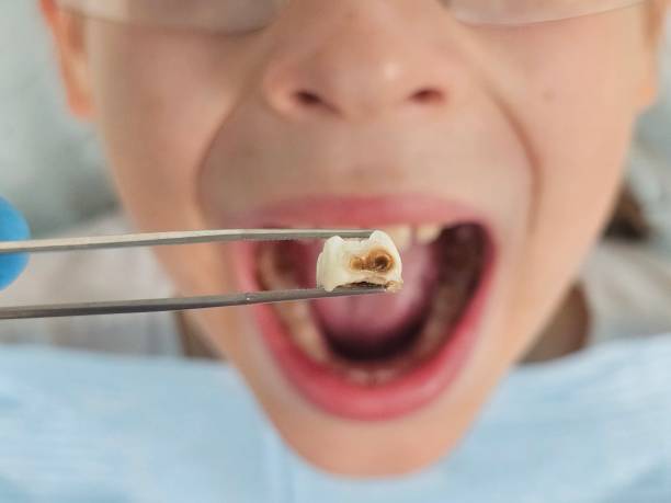 Best Emergency Tooth Extraction in Bohners Lake, WI